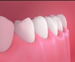 Periodontal (Gum) Surgery