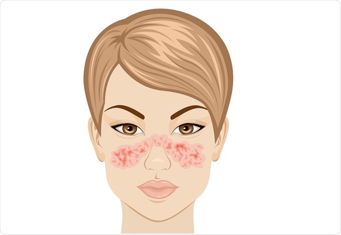 By Scio21 - Lupus cartoon