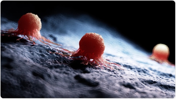 Illustration of a carcinoma - By Sebastian Kaulitzki Illustration of a carcinoma - By Sebastian Kaulitzki