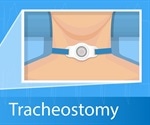 What is a Tracheotomy?