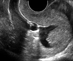 What is Sonohysterography?