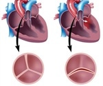 What is a Bicuspid Aortic Valve?