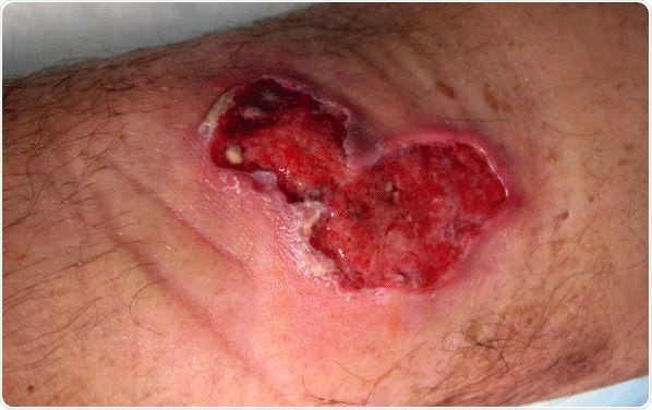 Image Credit: Buruli ulcer in a long-term traveler to Senegal. Image Credit: CDC