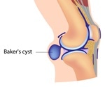 What is a Baker's Cyst?