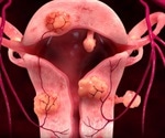 Uterine Artery Embolization: Technique and Complications