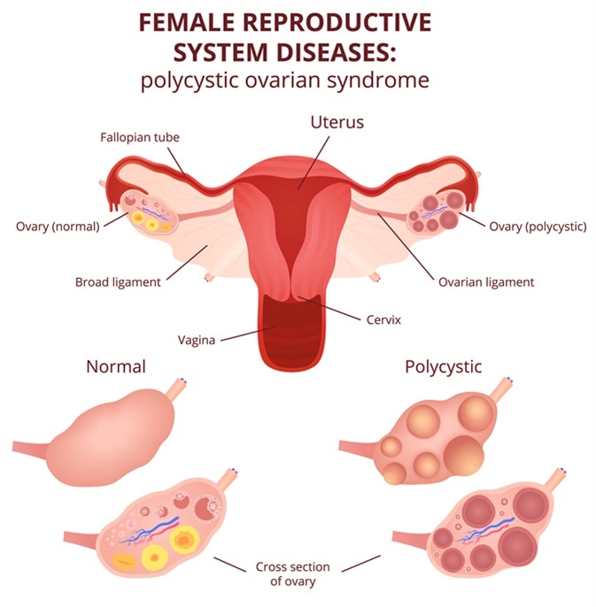 Female reproductive system, the uterus and ovaries scheme, polycystic ovary syndrome, ovarian cyst. Image Credit: Marochkina Anastasiia / Shutterstock