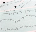 Unusual heart rhythm disorder common in people with long COVID