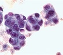 Missing cancer gene may boost response to immunotherapy