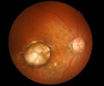 Study reveals new genetic insights into reticular pseudodrusen in people with AMD