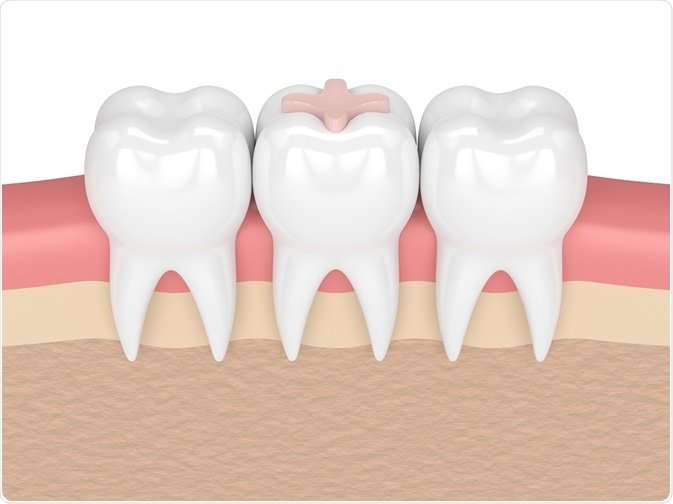 Bioactive glass for dentistry
