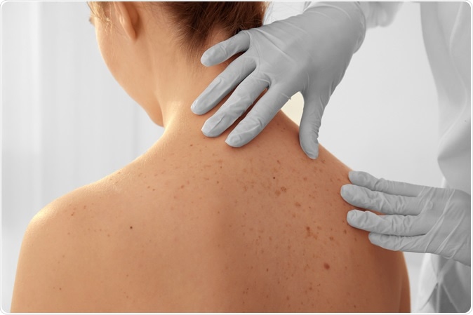 Dermatologist examining patient in clinic, closeup. Image Credit: Africa Studio / Shutterstock