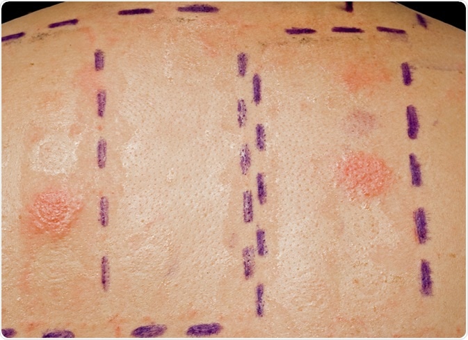 Skin Allergy Patch Test on Back of Patient Showing Redness and Swelling. Image Credit: Andy Lidstone / Shutterstock Skin Allergy Patch Test on Back of Patient Showing Redness and Swelling. Image Credit: Andy Lidstone / Shutterstock
