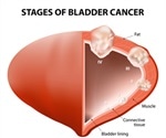 Bladder Cancer Types