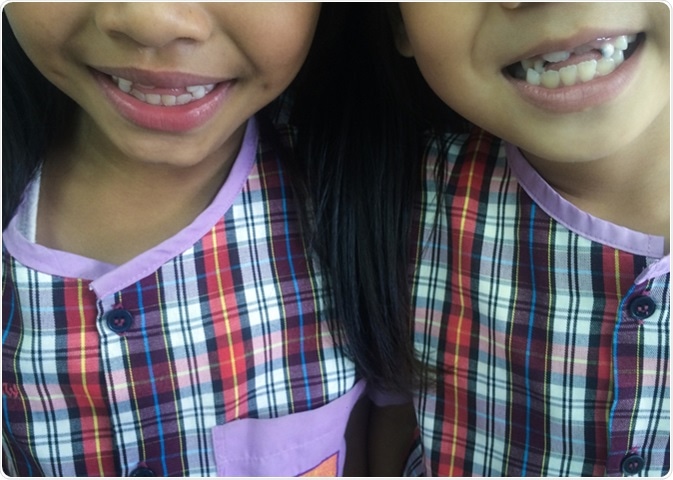 Ugly duckling stage smile from 2 young girls at primary school. Image Credit: Daran Jiravichitchai / Shutterstock
