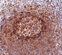 Study identifies C1orf122 as prognostic marker in liver cancer
