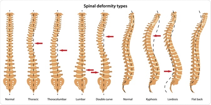Spinal deformity types. Anterior view and lateral view. Illustration Credit: Olga Bolbot / Shutterstock