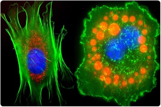 Globules of lipids, or body fats, cluster in a fibrous, pre-fat cell (shown in orange, left) and appear greatly expanded in a bulging mature fat cell on the right. Understanding lipid chemistry makes inroads to individualized medicine.