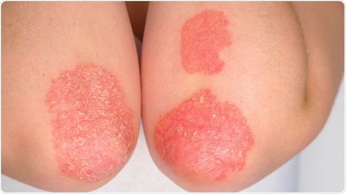 Psoriatic arthritis. Image Credit: Flystock / Shutterstock