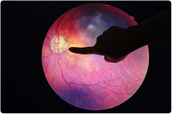 Diabetic Retinopathy. Image Credit: Anukool Manoton / Shutterstock