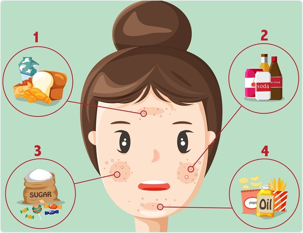 Acne and diet - infographic