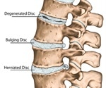 Degenerative Disc Disease Treatment and Self-Care