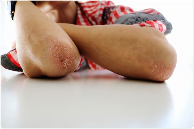 The interrelationships between characteristics of skin psoriasis, arthritis and the timing of arthritis are not well studied; the research sought to explore these in a large international cohort. Image Credit: KochaTango / Shutterstock