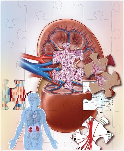 Researchers identify new kidney cancer subtypes and clues to better diagnosis, treatment