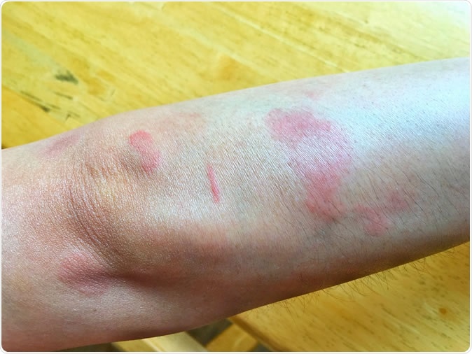 Systemic Lupus Erythematosus(SLE) is a chronic disease caused by self-immunity which causes Effects on the organs in the body, especially the skin, joints, blood, kidneys and central nervous system. Image Credit: Korn Ratchaneekorn / Shutterstock