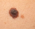 Study hints why some melanomas more likely to spread