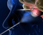Recovery from Endoscopic Endonasal Surgery