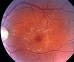 What is Fundus Flavimaculatus?