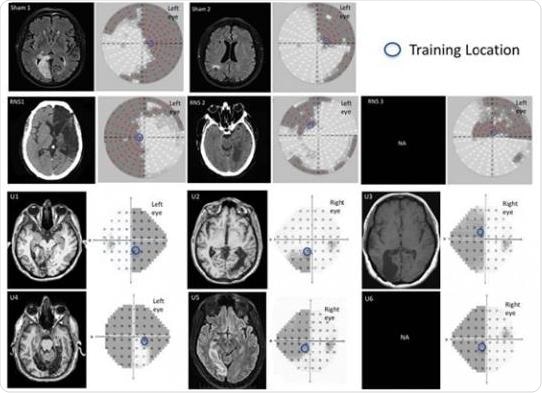 Brain stimulation accelerates visual learning and recovery