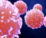 What is Large Granular Lymphocytic Leukemia (LGLL)?