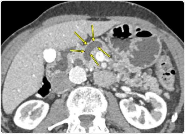 Early removal of some pancreatic cysts could decrease cancer risk, save lives