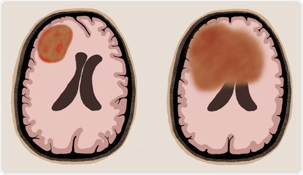 Surgery can be beneficial for one type of primary central nervous system lymphoma