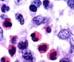 What is Langerhans Cell Histiocytosis?