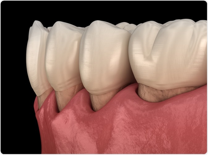 Gum recession process. 3D illustration. Credit: Alex Mit / Shutterstock