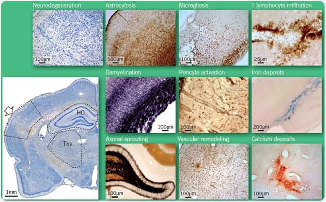 Open arrow, primary injury; HC, hippocampus; Tha, thalamus. Photomicrographs were taken from the outlined areas of the rat brain.