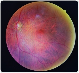 Diabetic retinopathy