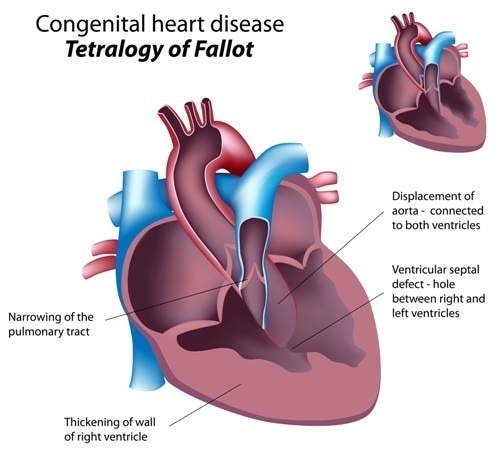 Congenital heart disease : Tetralogy of Fallot. Image Credit: Alila Medical Media / Shutterstock