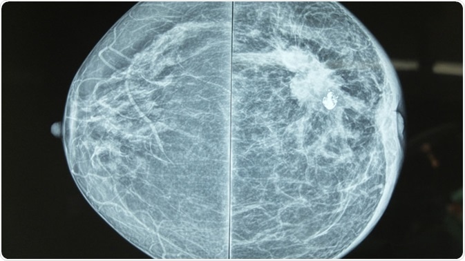 Mammography image showing left breast calcification to suggest malignancy. Image Credit: Casa Nayafana / Shutterstock