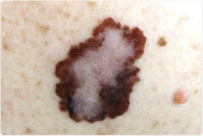 Melanoma. Image Credit: Nasekomoe / Shutterstock