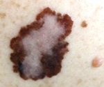 New nanovaccine for deadly skin cancer