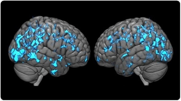 Johns Hopkins researchers reveal why deep brain stimulation improves Parkinson’s symptoms