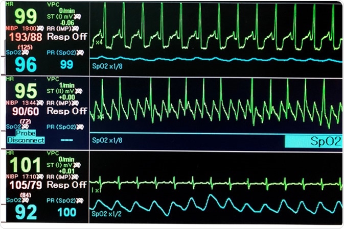 Vital sign EKG monitor. Image Credit: Duangnapa Kanchanasakun / Shutterstock