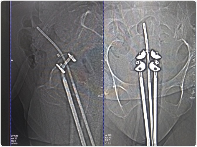 Brachytherapy applicator on CT scan. Image Credit: Chandrasekar28 / Shutterstock