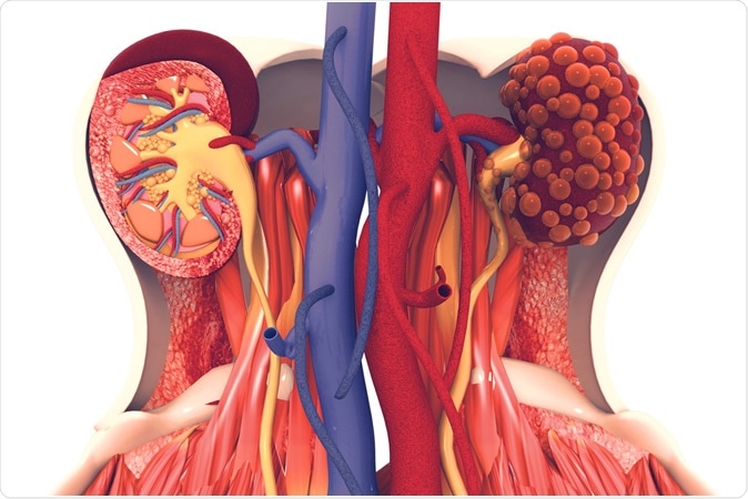 Kidney disease. 3d illustration, Credit: Crystal Light / Shutterstock
