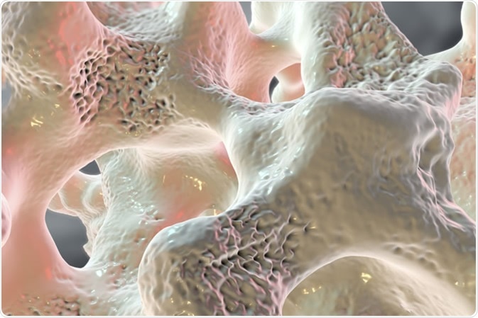 Spongy bone tissue affected by osteoporosis, 3D illustration - Image Credit: Kateryna Kon / Shutterstock