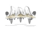DePuy Synthes launches ATTUNE Cementless Knee in rotating platform option