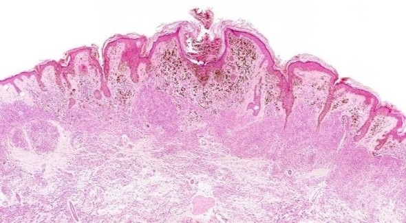 Johns Hopkins researchers link a gene to melanoma growth and spread